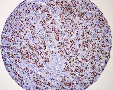 Representative immunohistochemistry result. Adrenocortical carcinoma tissue array stained with anti-CDK9.